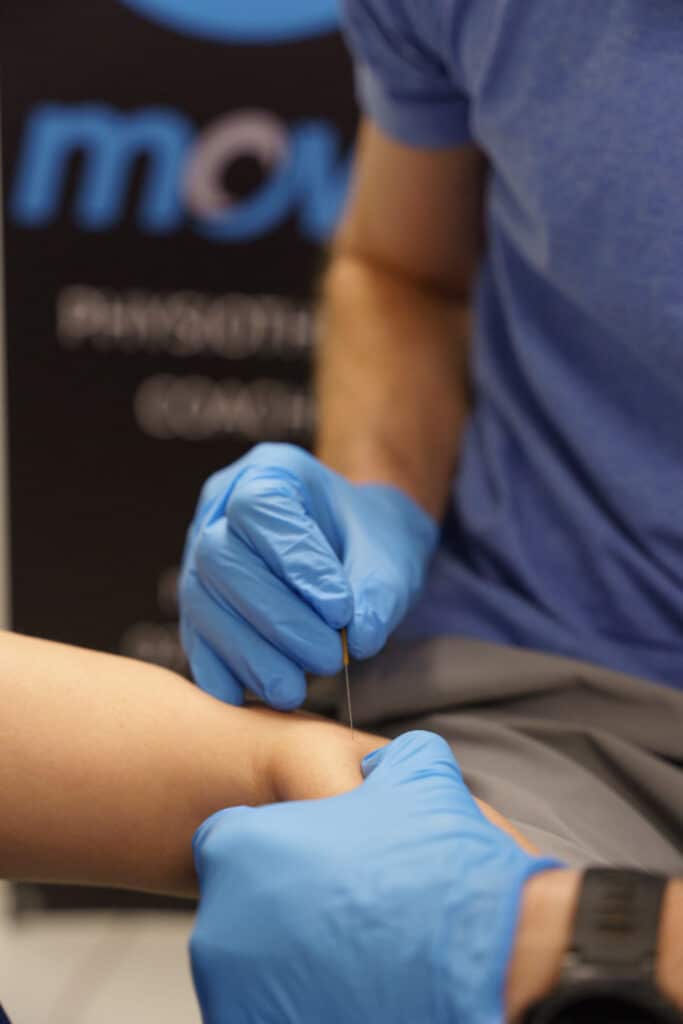dry needling sur une tendinite ou tendinopathie, ici épicondylite ou tennis elbow