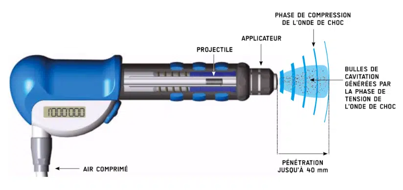 Schéma du fonctionnement des ondes de choc radiales pour les traitement de physio
