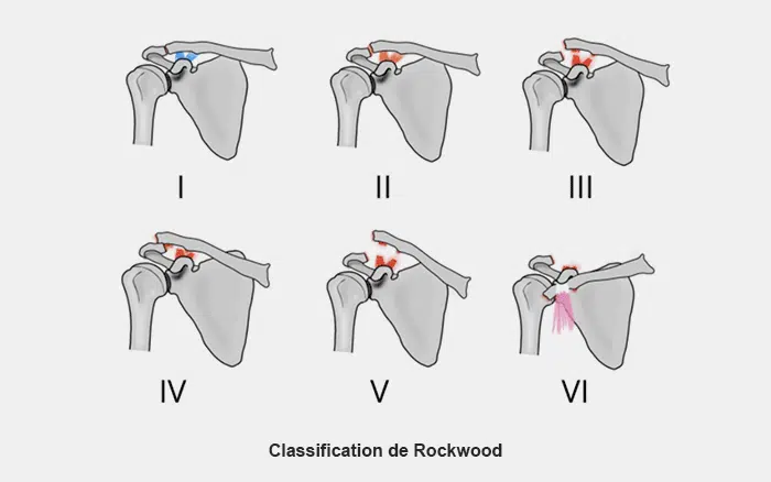 classification de rockwood dans les entorses acromio-claviculaires