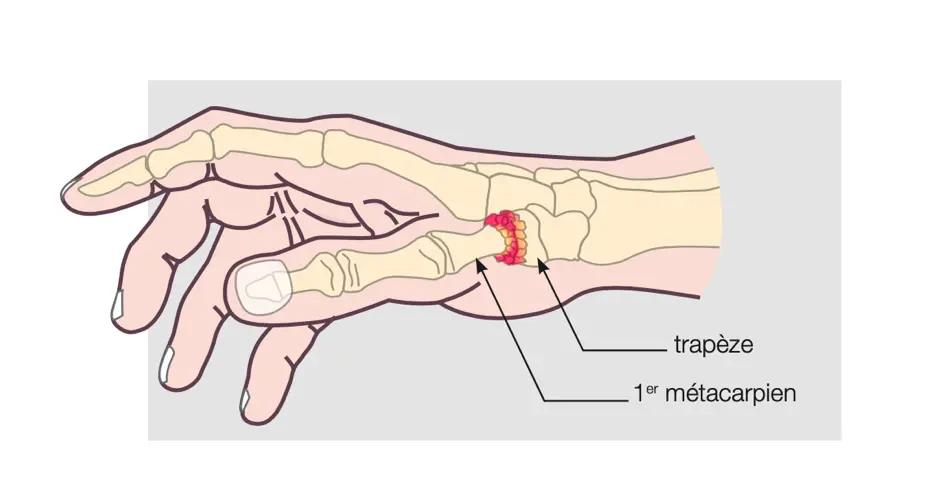 arthrose-pouce